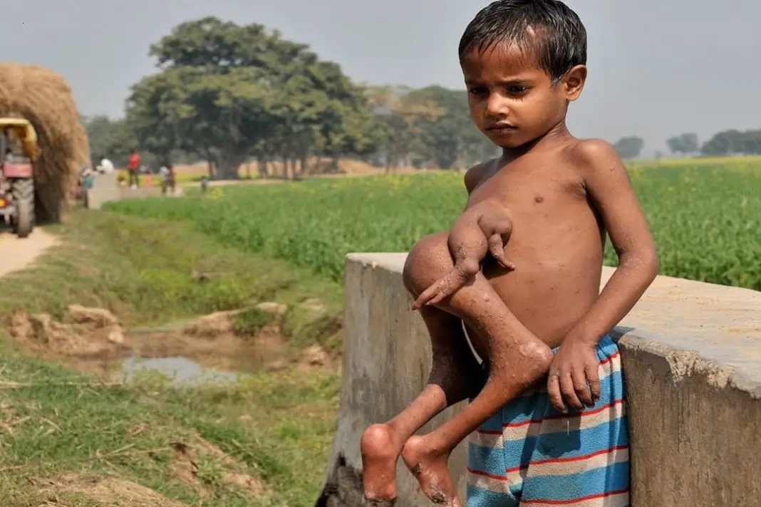 Four-limbed baby born in West Bengal leaves locals amazed and intrigued.