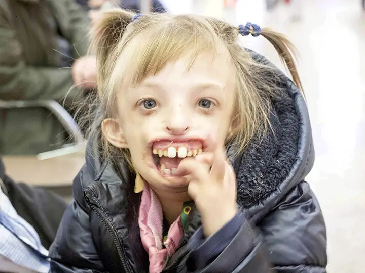 An Amazing Story: A Girl Who Lost Half Her Face, Rediscovered in Russia and the UK via Surgery