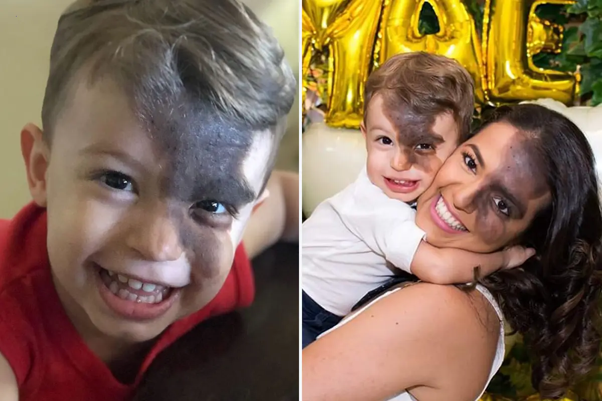 Unconditional Love: Mother Applies Makeup and Birthmark to Embrace Son’s Uniqueness, Defying Ridicule
