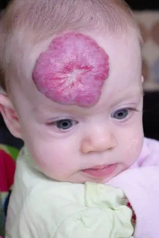 The story of the resilience of a little girl embracing her birthmark the size of a pomegranate with ɡгасe and pride