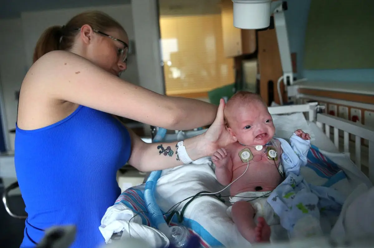 Amazing Jo-Rey, an Alabama Baby Without a Nose Embraced by a Loving Mother (Video)
