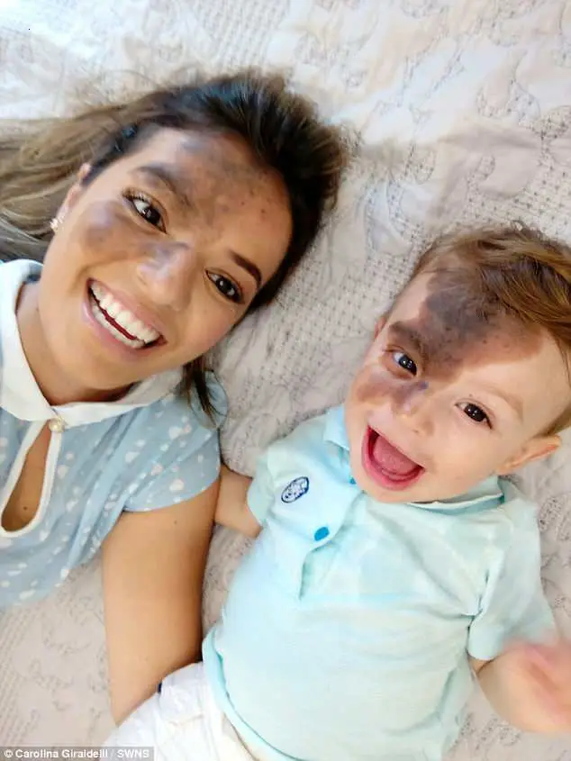 The mother applied makeup and drew birthmarks on her face to look like her son so that she would no longer be self-conscious in the face of everyone’s ridicule