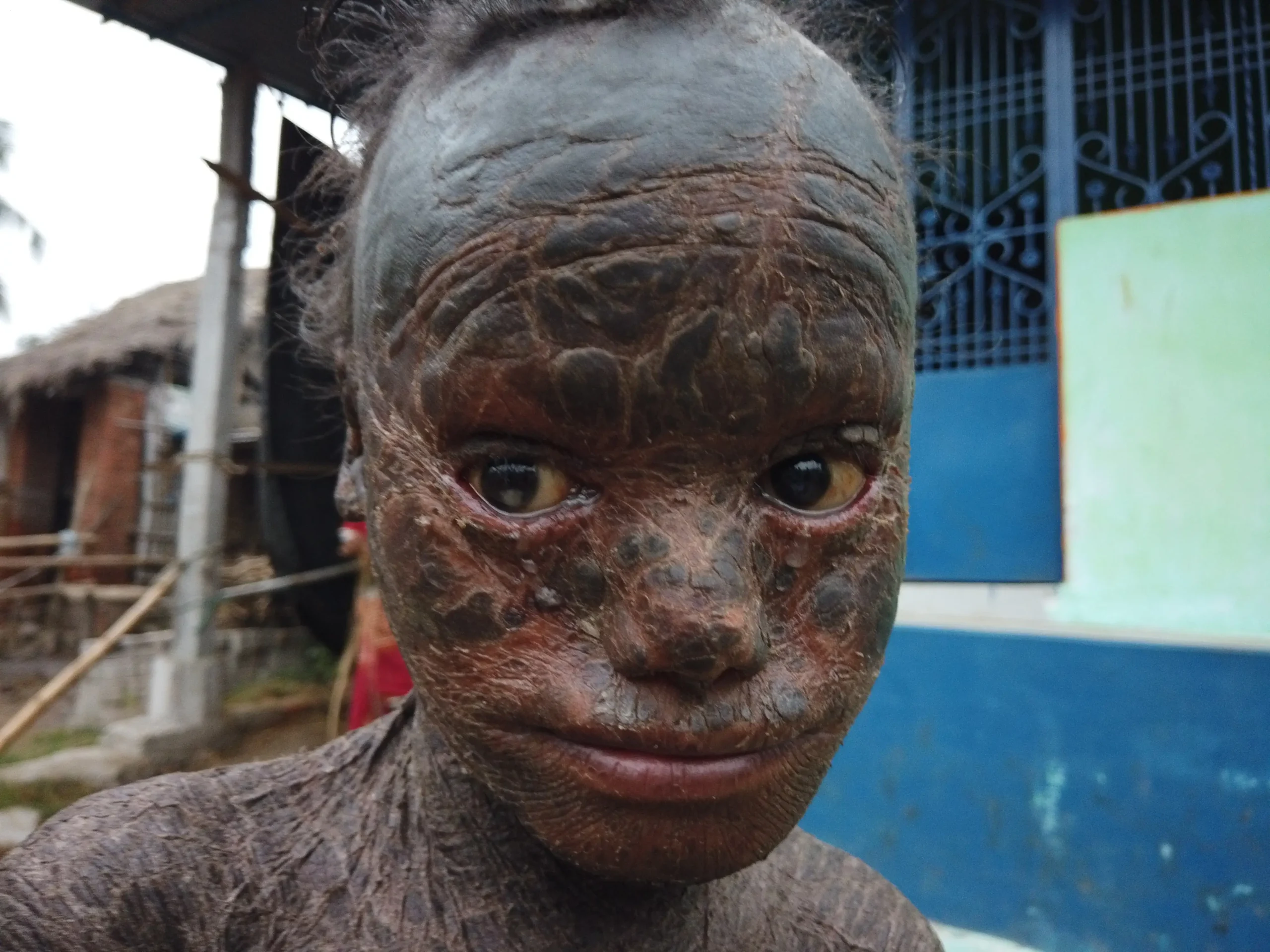 Revealing the ‘Speech Maven’: A 10-Year-Old with Unique Skin Since Birth