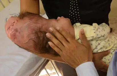 A Two-Headed Newborn’s Remarkable Journey Surprises and Inspires All