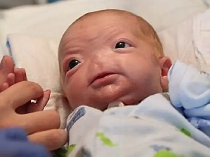 Amazing Jo-Rey, an Alabama Baby Without a Nose Embraced by a Loving Mother (Video)