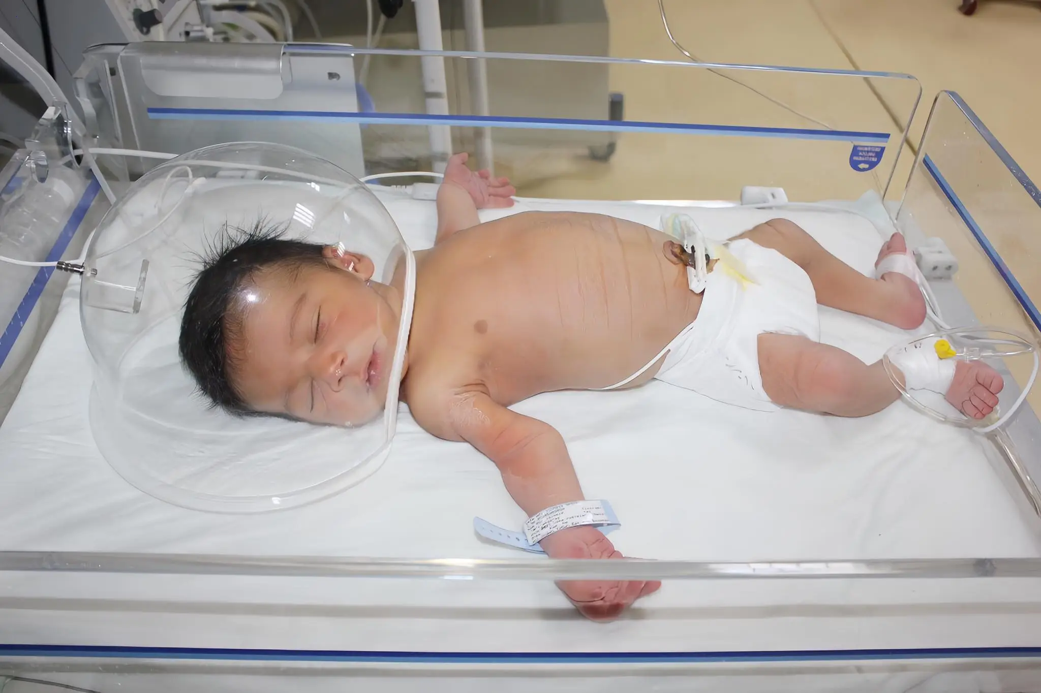 Triumph over adversity: The inspirational journey of strength of a three-legged infant
