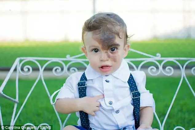The mother applied makeup and drew birthmarks on her face to look like her son so that she would no longer be self-conscious in the face of everyone’s ridicule