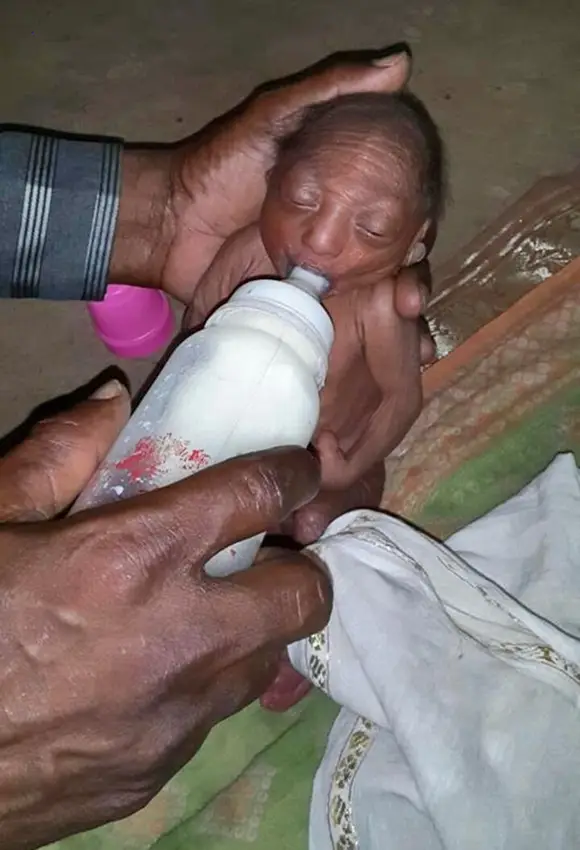 The discovery of a newborn baby with a skateboard as wrinkled as a map of a 75-year-old man shocked the villagers.
