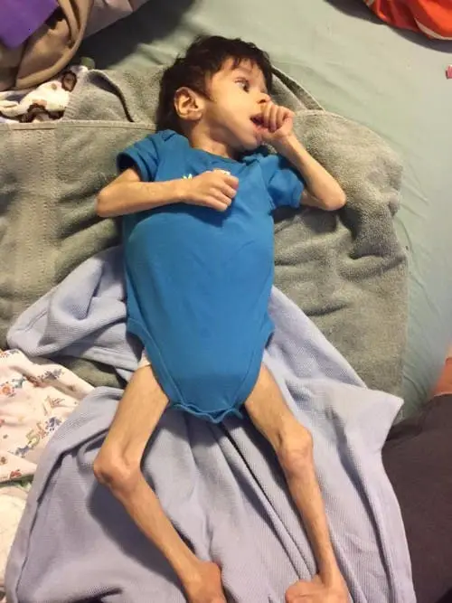 The astonishing act of a child woman adopting a 7-year-old boy weighing 3.6 kg is quite amazing (Video.)