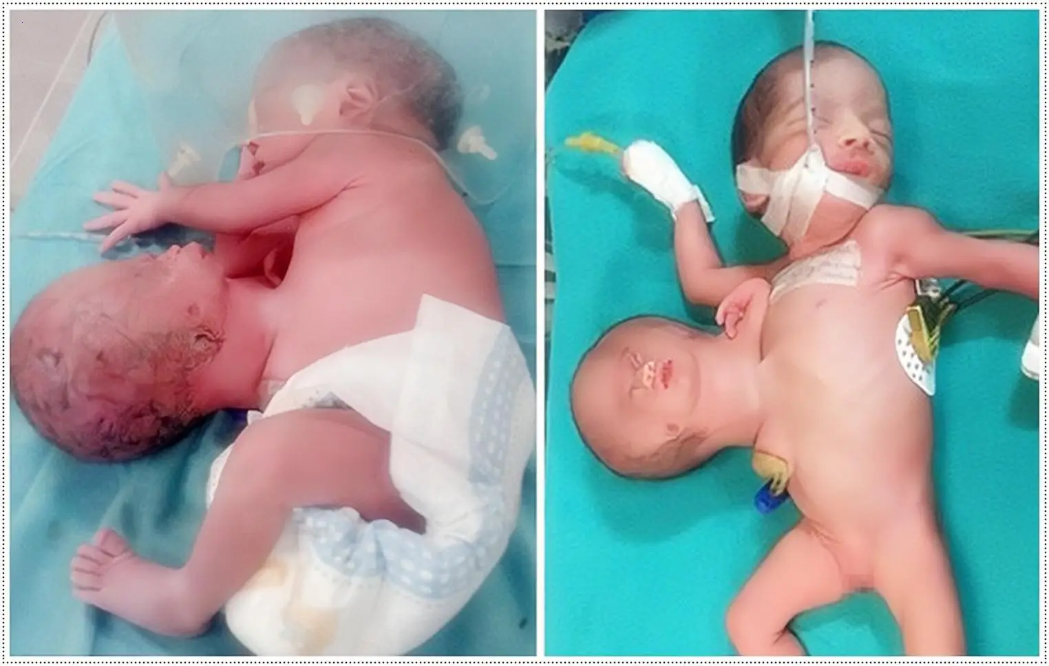 The two-headed newborn boy evokes medical puzzles and cautious optimism for his future