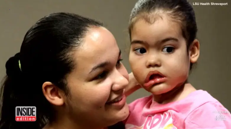 A medical miracle saved the life of a little girl with a sagging tumor under her chin.