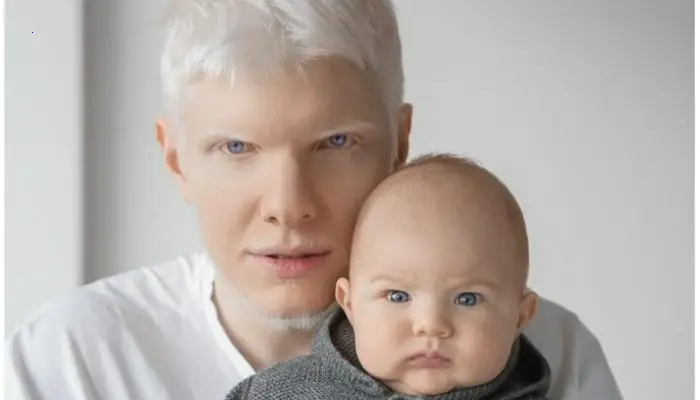Everyone was perplexed when she married an albino and revealed her baby to the world