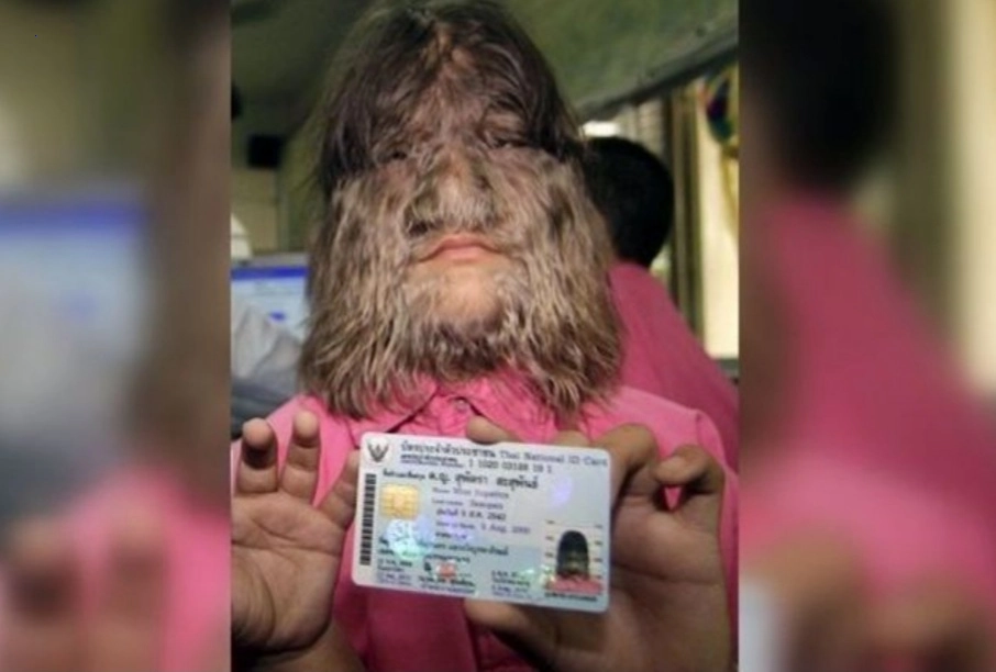 The world’s hairiest woman chose to get her facial hair removed. This is how she looks right now.