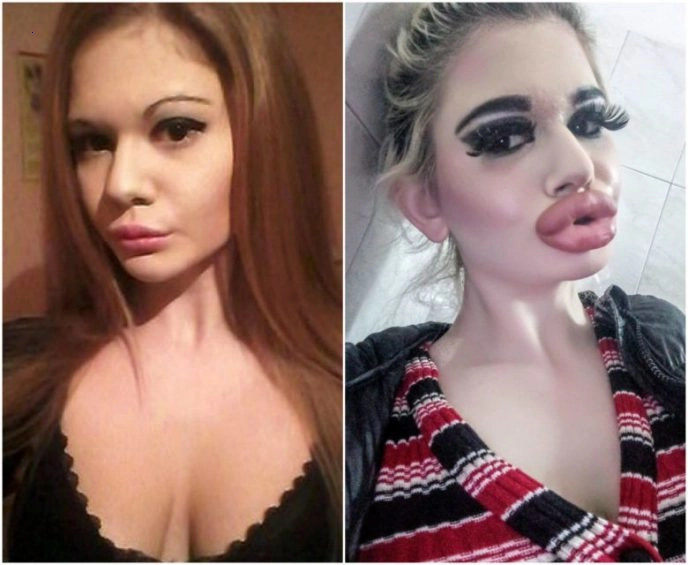 Check Out What a 22-Year-Old Girl Looked Like Before Plastic Surgery in “Surgeons Disfigured The Beauty”