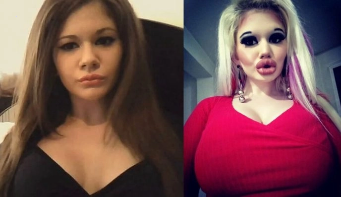 Check Out What a 22-Year-Old Girl Looked Like Before Plastic Surgery in “Surgeons Disfigured The Beauty”