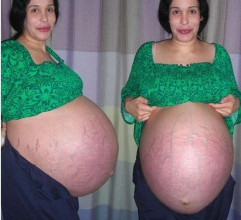 What Nadia Suleman looks like today, after giving birth to eight children in 2009, having already had six.